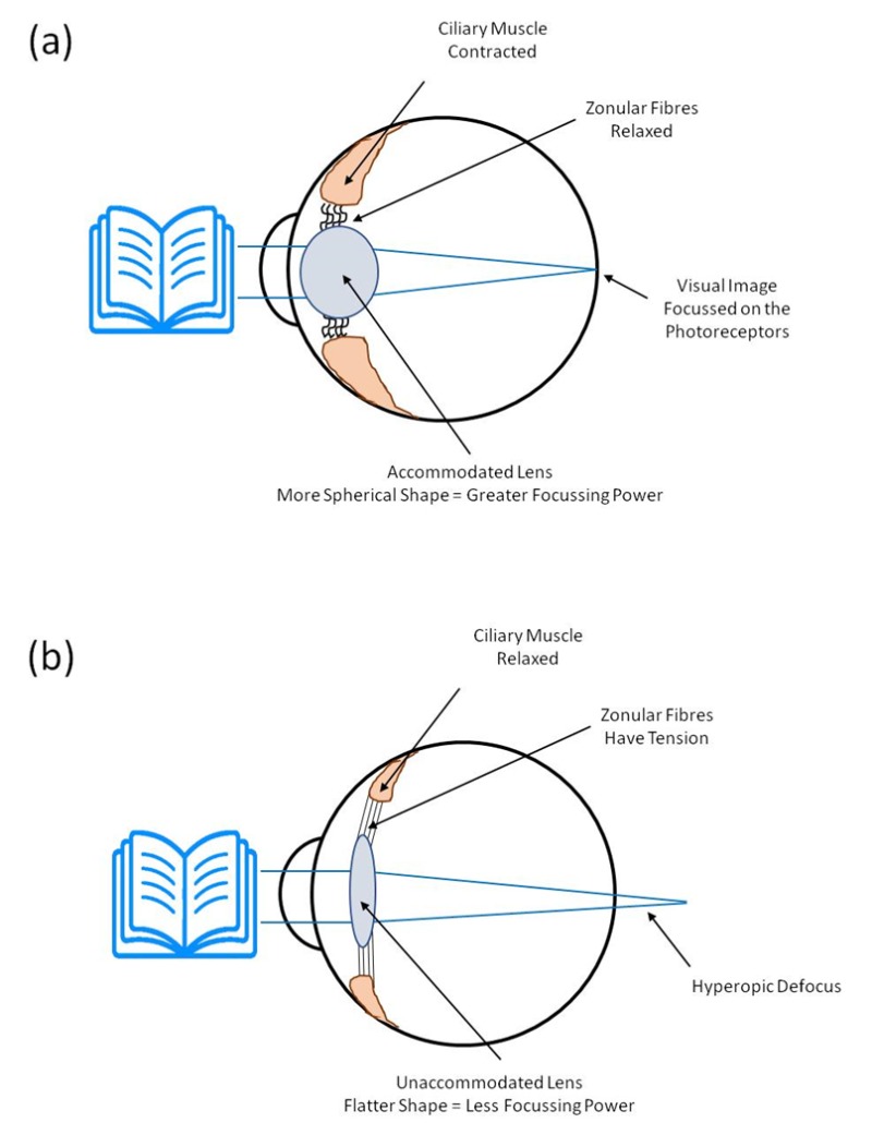 Near vision (a): ciliary muscle contracted, zonular fibres relaxed, lens accommodated to a more spherical, higher-power shape, focusing the image on the photoreceptors. Far vision (b): ciliary muscle relaxed, zonular fibres under tension, lens flatter and lower-power.