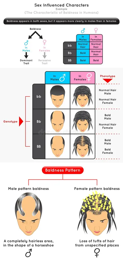 Sex-influenced pattern baldness: genotype-to-phenotype table (bb = normal hair in both sexes; Bb = bald in males, normal in females; BB = bald in both sexes), illustrated with male vs. female head diagrams for each genotype, plus the distinct male (“horseshoe”) vs. female (diffuse thinning) baldness pattern shapes.