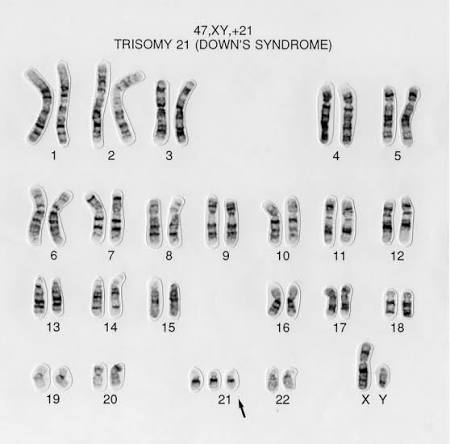 Human karyotype (47, XY, +21): all 22 autosome pairs plus X and Y, with three copies of chromosome 21 instead of two, confirming trisomy 21 / Down syndrome.