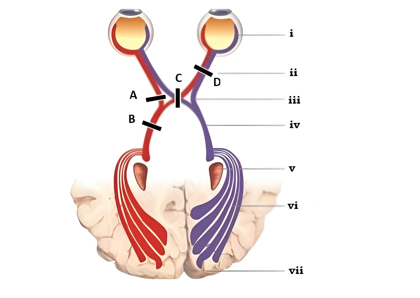 Visual pathway diagram showing interruption points A–D along the pathway from retina to visual cortex