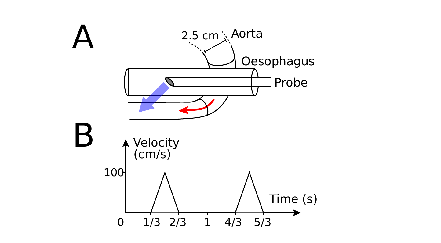 Diagram of Doppler probe placement in the esophagus near the aorta, and a velocity-time waveform showing a peak systolic velocity of 100 cm/s over a repeating cardiac cycle.