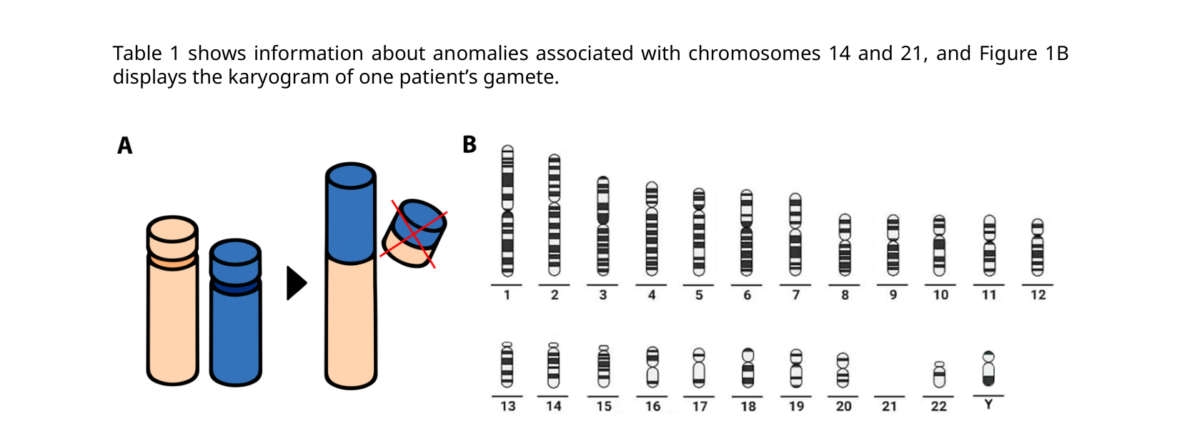 Panel A: two acrocentric chromosomes fusing at their centromeres into one large chromosome, losing their short arms. Panel B: a full human karyogram of a gamete, with chromosome 21 missing.
